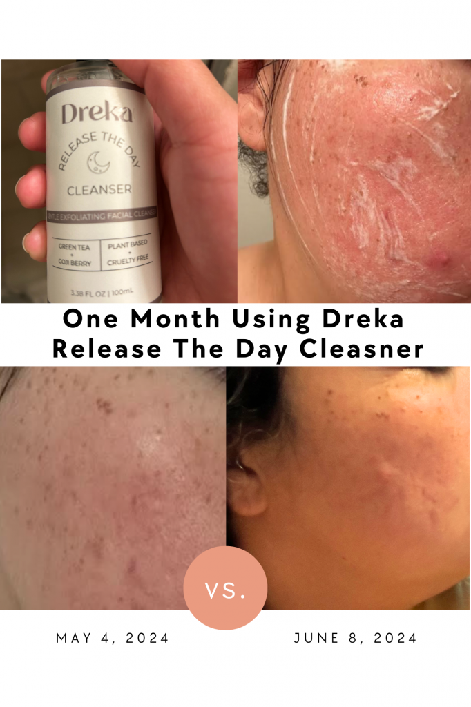One month after using DREKA the best skin care set